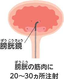 膀胱鏡 膀胱の筋肉に20~30ヵ所注射 イメージ図