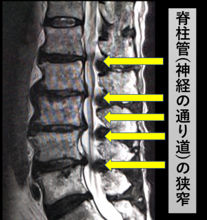 図2　腰部脊柱管狭窄症のMRI像