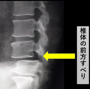 図3　不安定性のある腰椎変性すべり症のレントゲン像