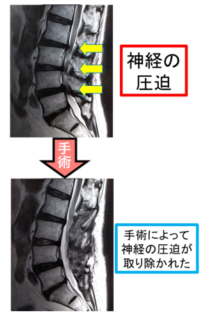 図4　除圧術による狭窄の改善