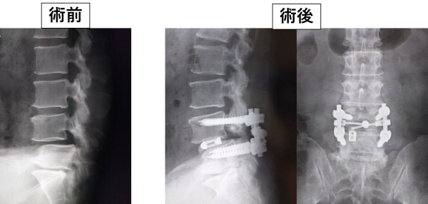 図6　腰椎変性すべり症に対する腰椎後方椎体間固定術