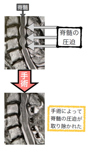 図2　頚椎症性脊髄症の手術前後のMRI像