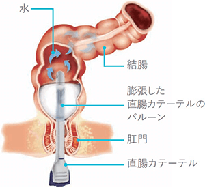 経肛門的洗腸療法とは