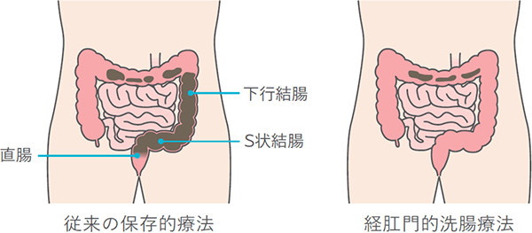 経肛門的洗腸療法の効果イメージ図